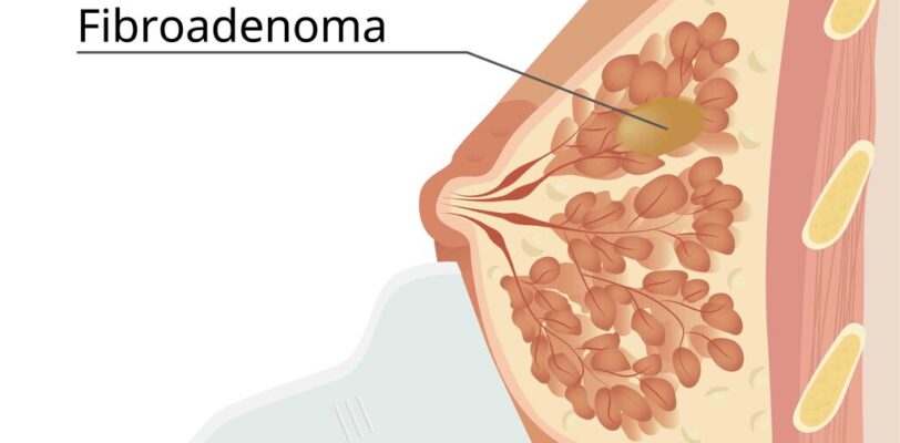 Fibroadenoma al seno-Prof. Massimo Vergine