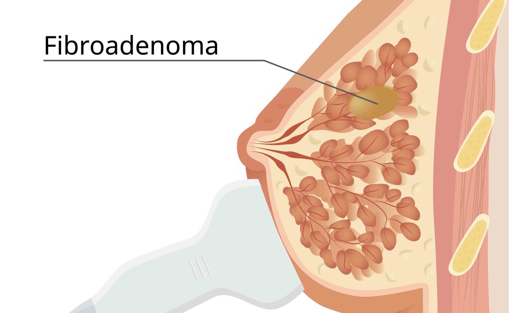 Fibroadenoma al seno-Prof. Massimo Vergine