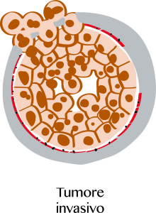 carcinoma mammario B5b