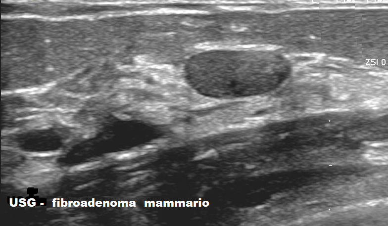 Fibroadenoma al seno-Prof. Massimo Vergine-Senologo policlinico Umberto I di Roma
