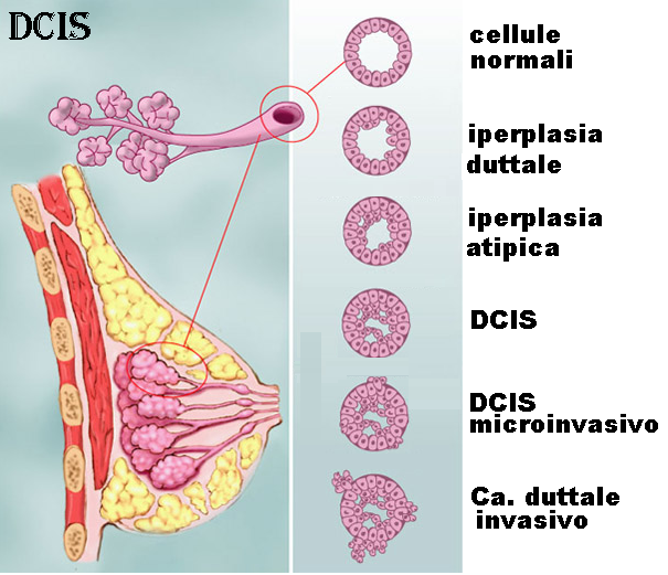 Iperplasia duttale atipica- prof. Massimo Vergine-Chirurgo- senologo policlinico Umberto I di Roma