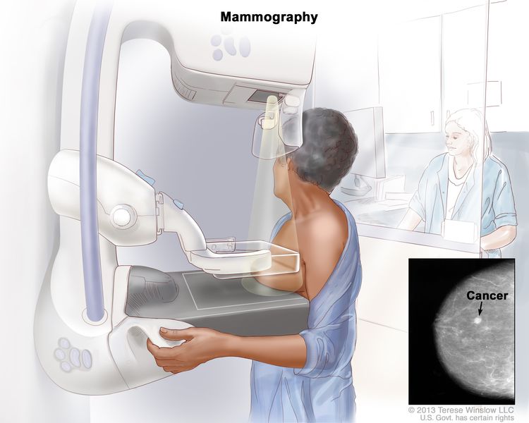 Mammografia per la diagnosi precoce